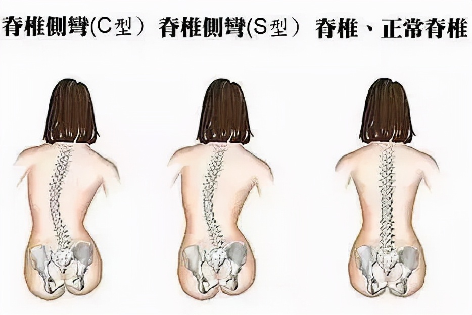 孩子脊椎變形的原因您知道多少?